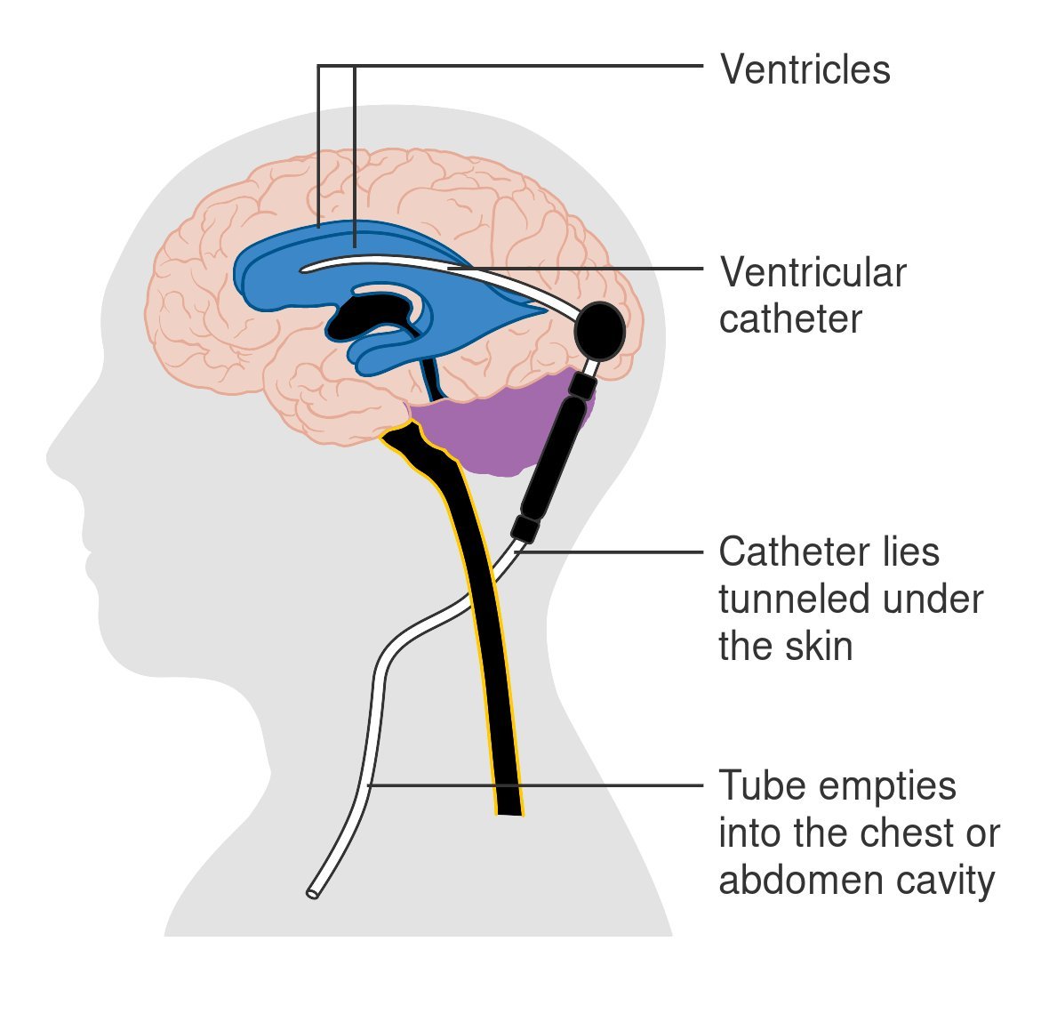 A ventriculoperitoneal shunt, used to drain excess fluid from the brain
