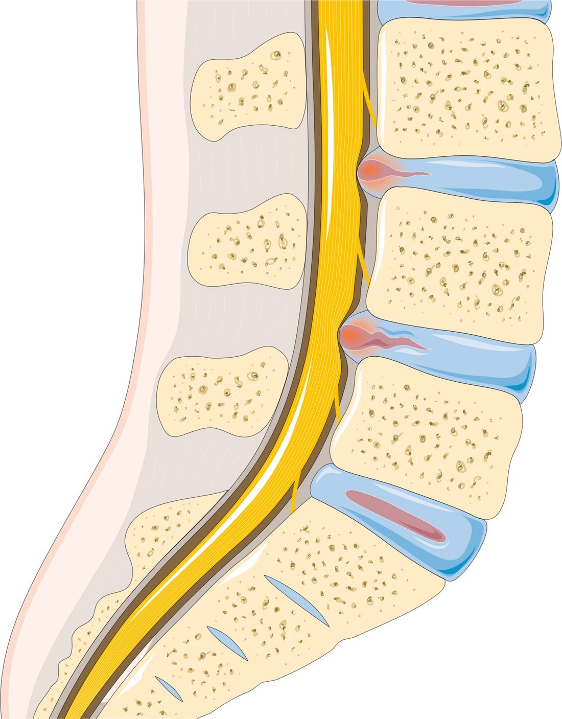 A herniated disc bulging and pressing on a nearby nerve root