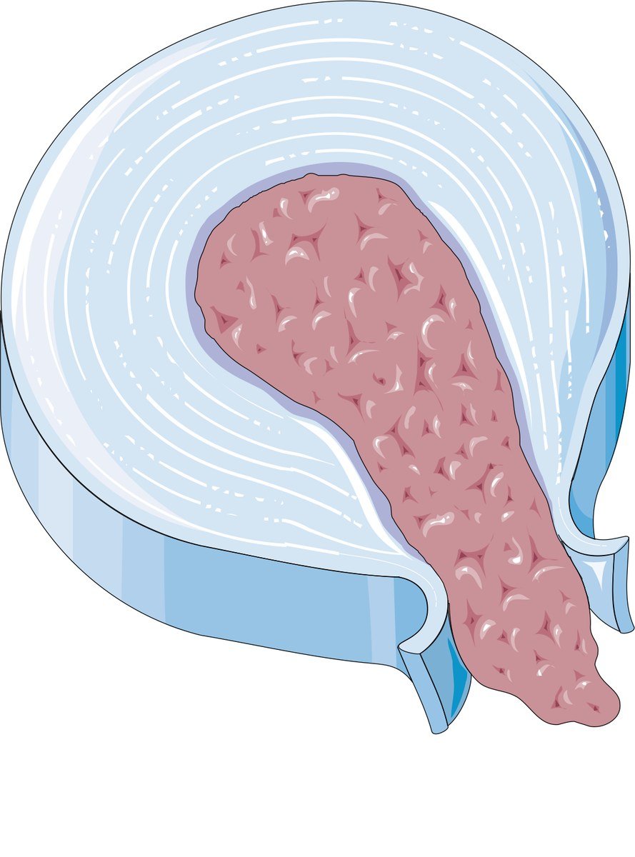 A disc extrusion, where disc material breaks through the outer ring